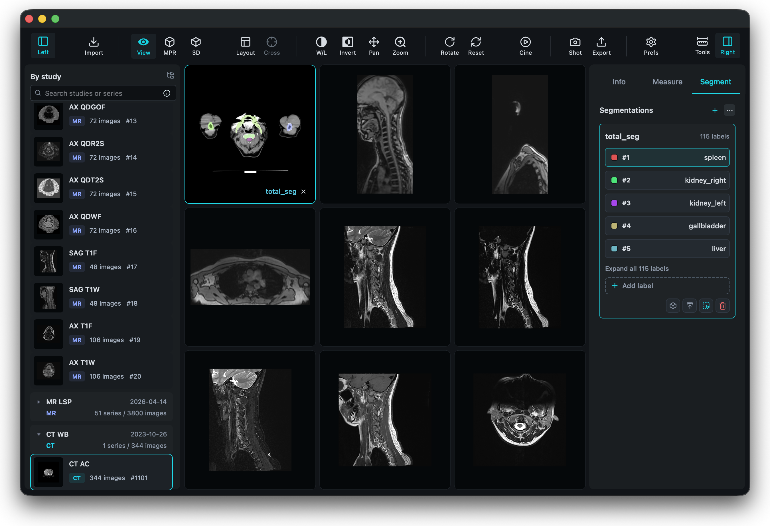 VisoRay multi-viewport DICOM image browsing interface