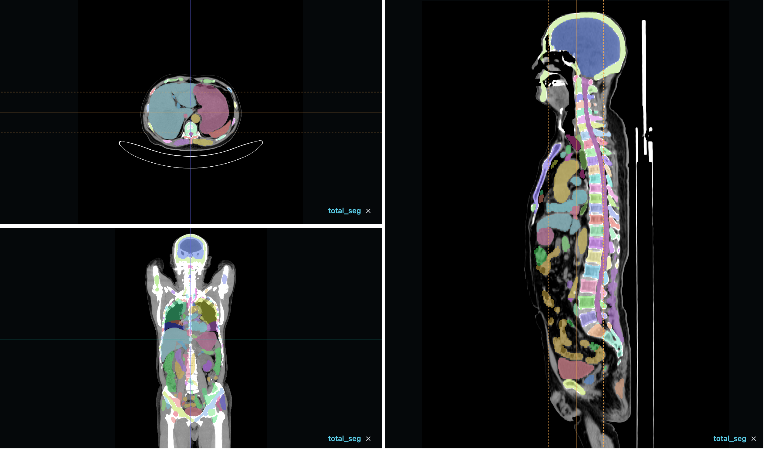 VisoRay MPR three-plane view with positioning lines and segmentation overlay